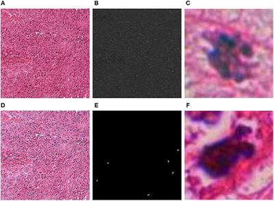 Deep Learning for Semantic Segmentation vs. Classification in Computational Pathology: Application to Mitosis Analysis in Breast Cancer Grading